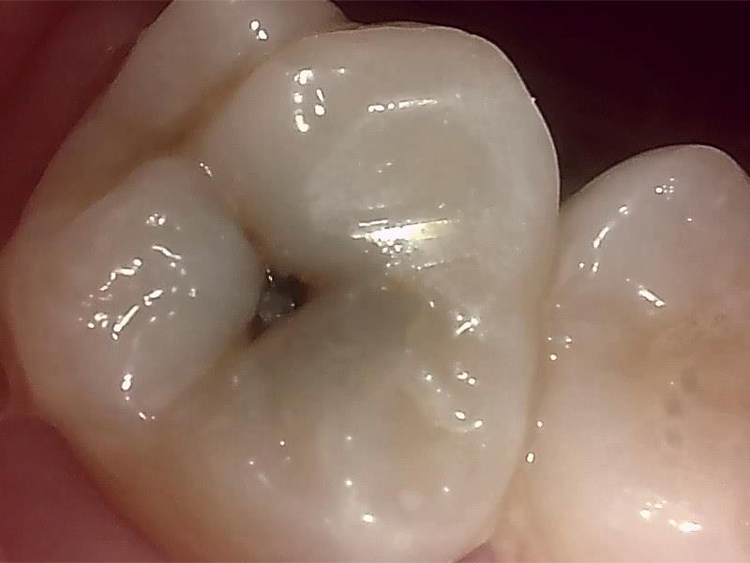感染歯質の除去1