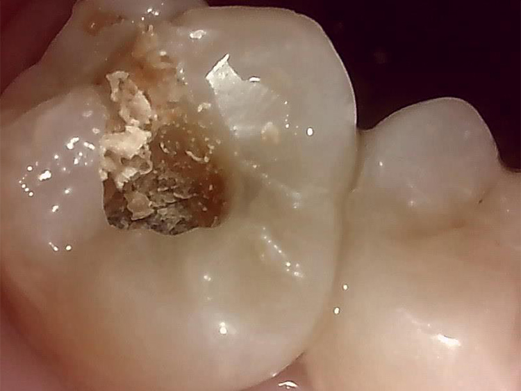 感染歯質の除去3