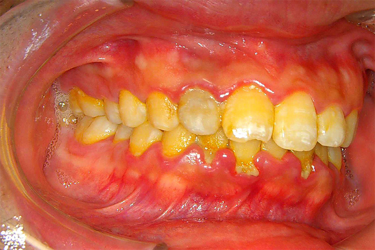 実際の歯肉炎の画像1