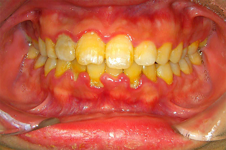 実際の歯肉炎の画像2