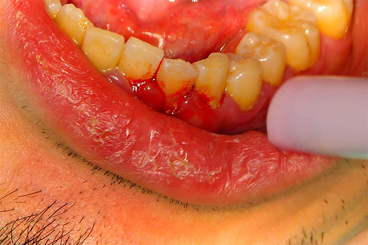 実際の歯肉炎の画像4