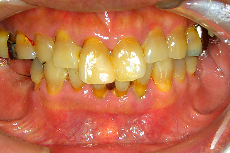 歯周病　口腔内写真2