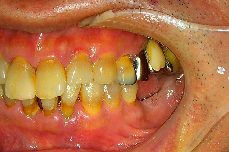 歯周病　口腔内写真3