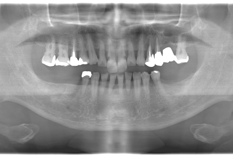 歯周病　実際のパノラマ画像