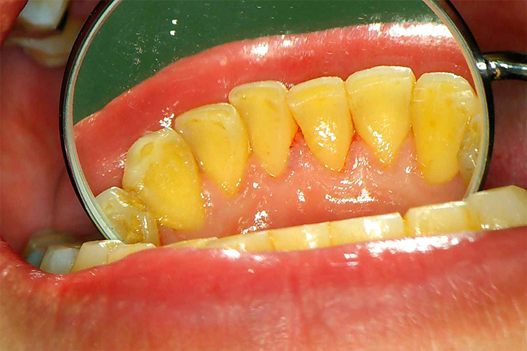歯石除去の術前術後