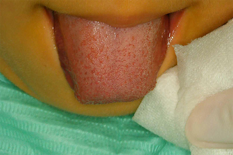 舌小帯強直症