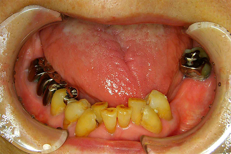 PDの鈎歯3