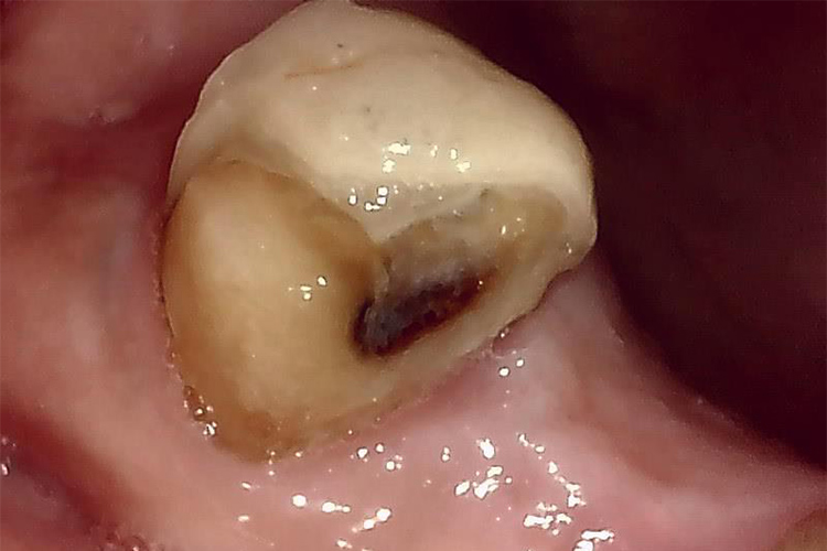 詰め物が取れてしまってもすぐに治療をしなかった方の状態4