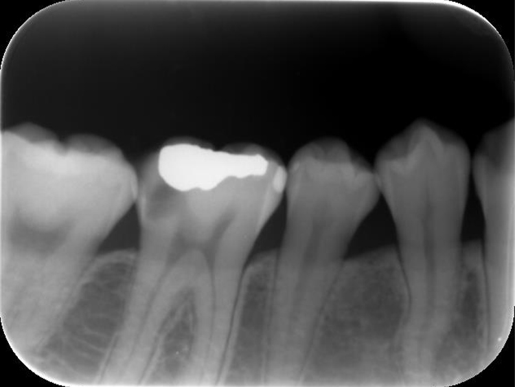 数年前に金属で修復した部分に新しく虫歯ができた一例1