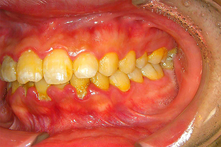 実際の歯肉炎の画像3